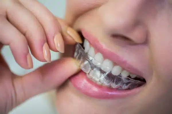 Choose Mouthguard Oxley Dental